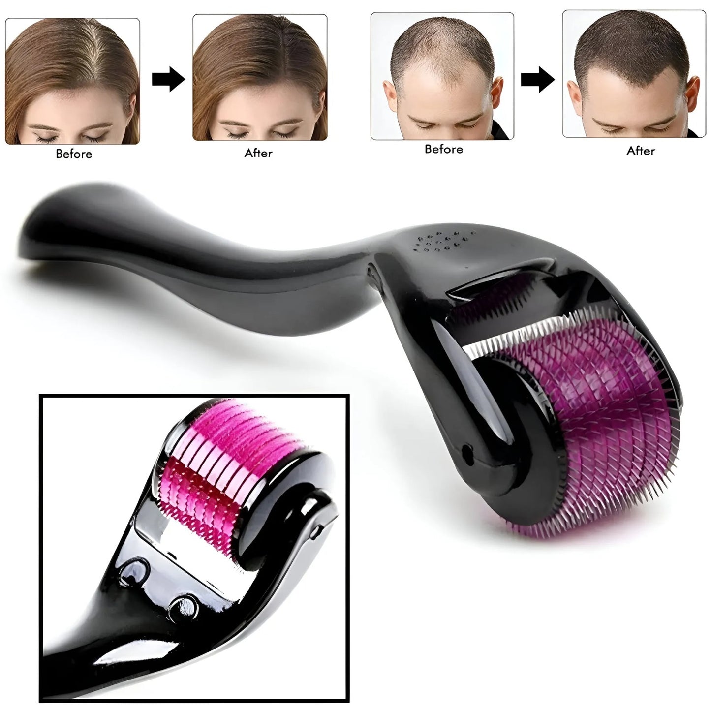 Derma Roller Dynamic Life 0.5mm - 540 Microneedle System for Hair Growth & Skin Therapy